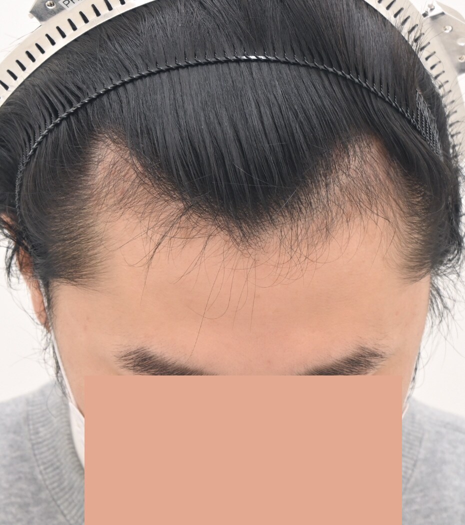 自毛 症例5