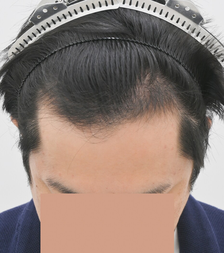自毛 症例6　after