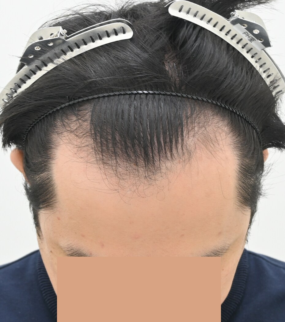 自毛 症例6