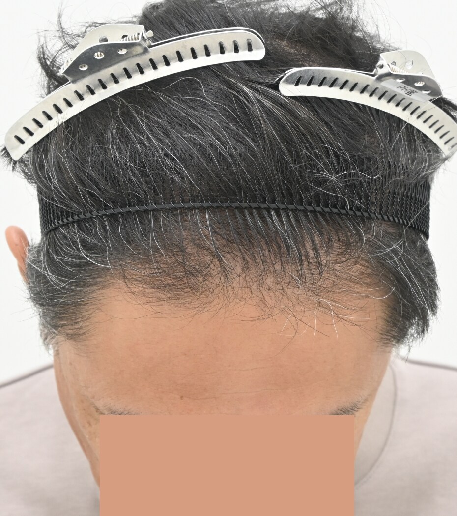 自毛 症例7　after