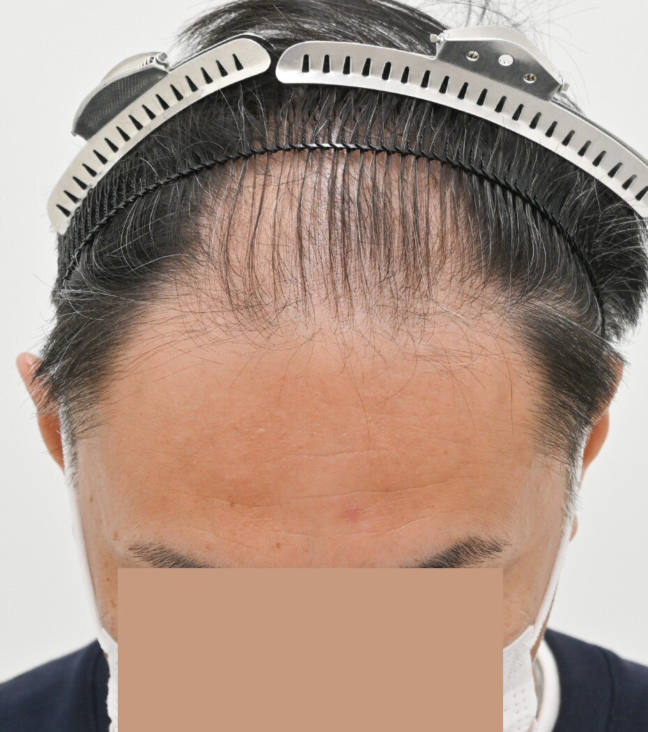 自毛 症例7