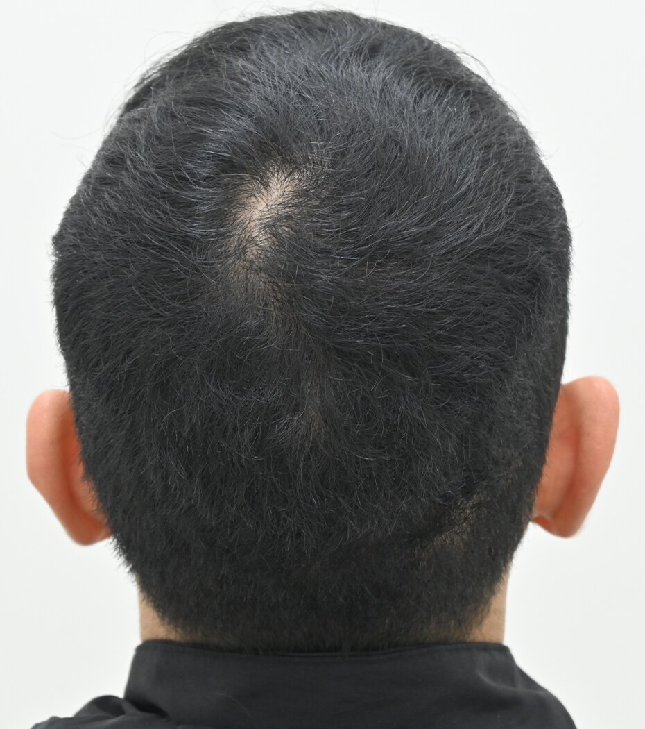 自毛 症例8 after
