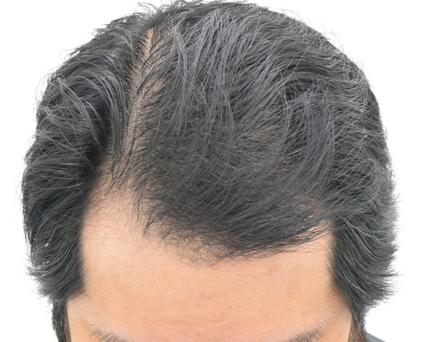 自毛 症例1 after