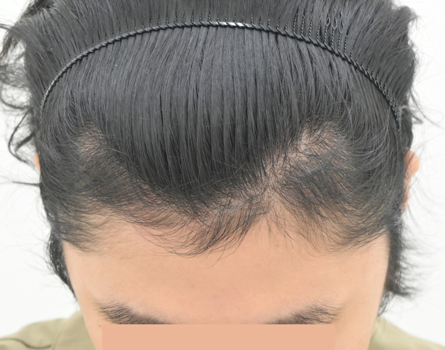 自毛 症例3 after