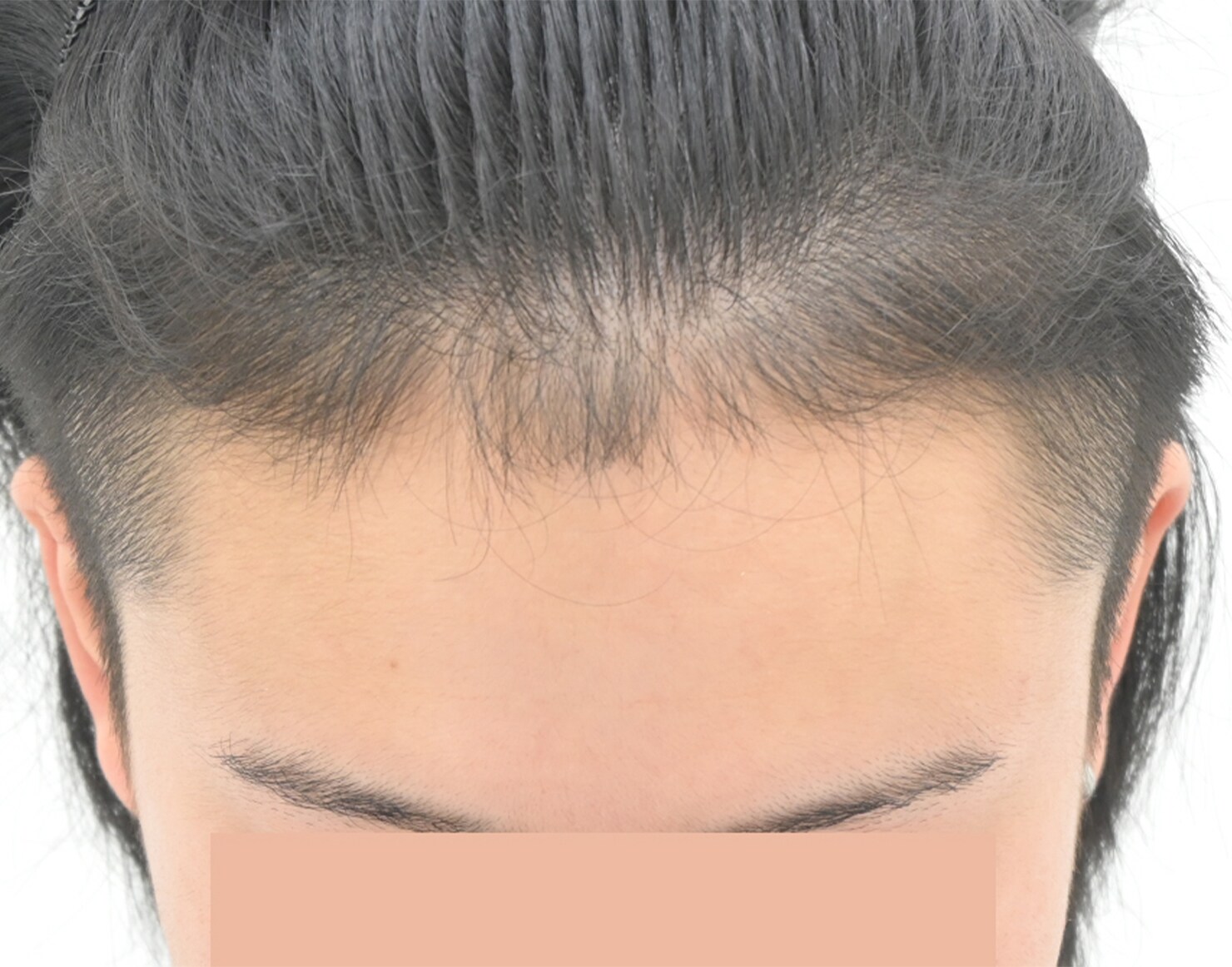 自毛 症例4 after