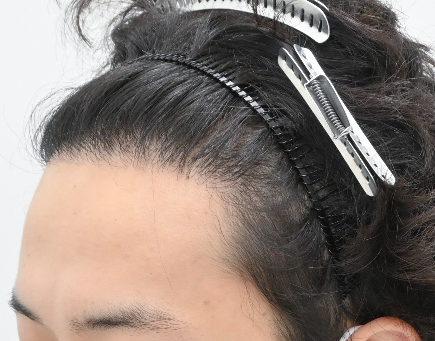自毛 症例2
