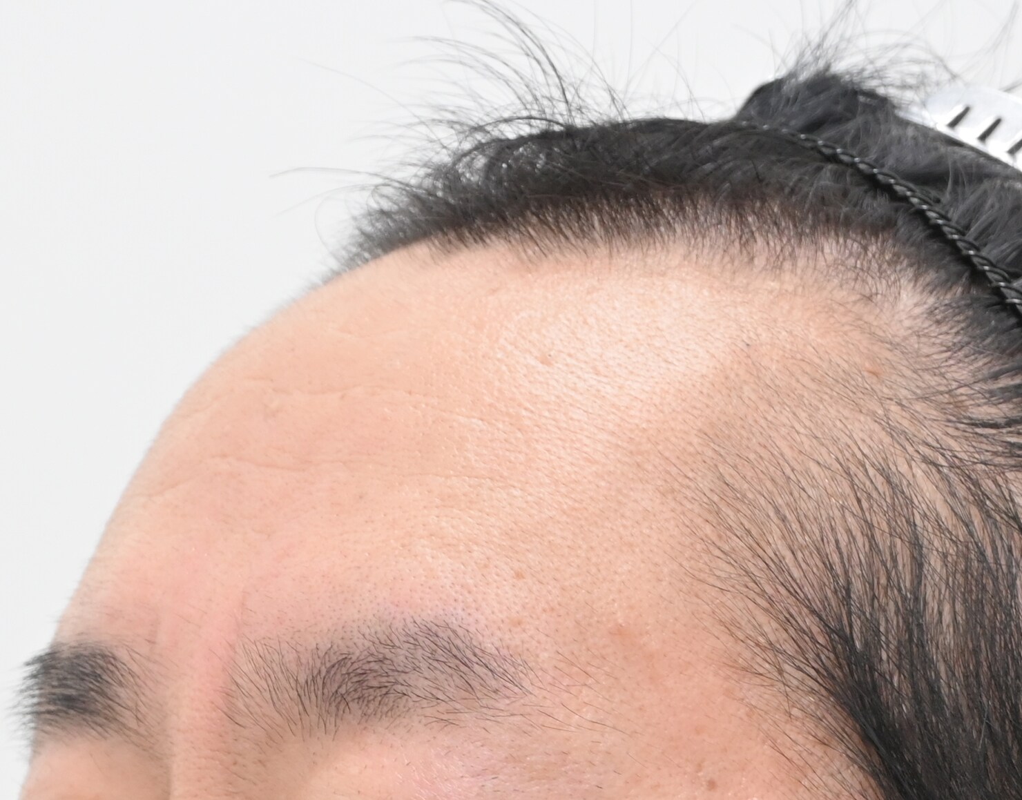 自毛 症例1