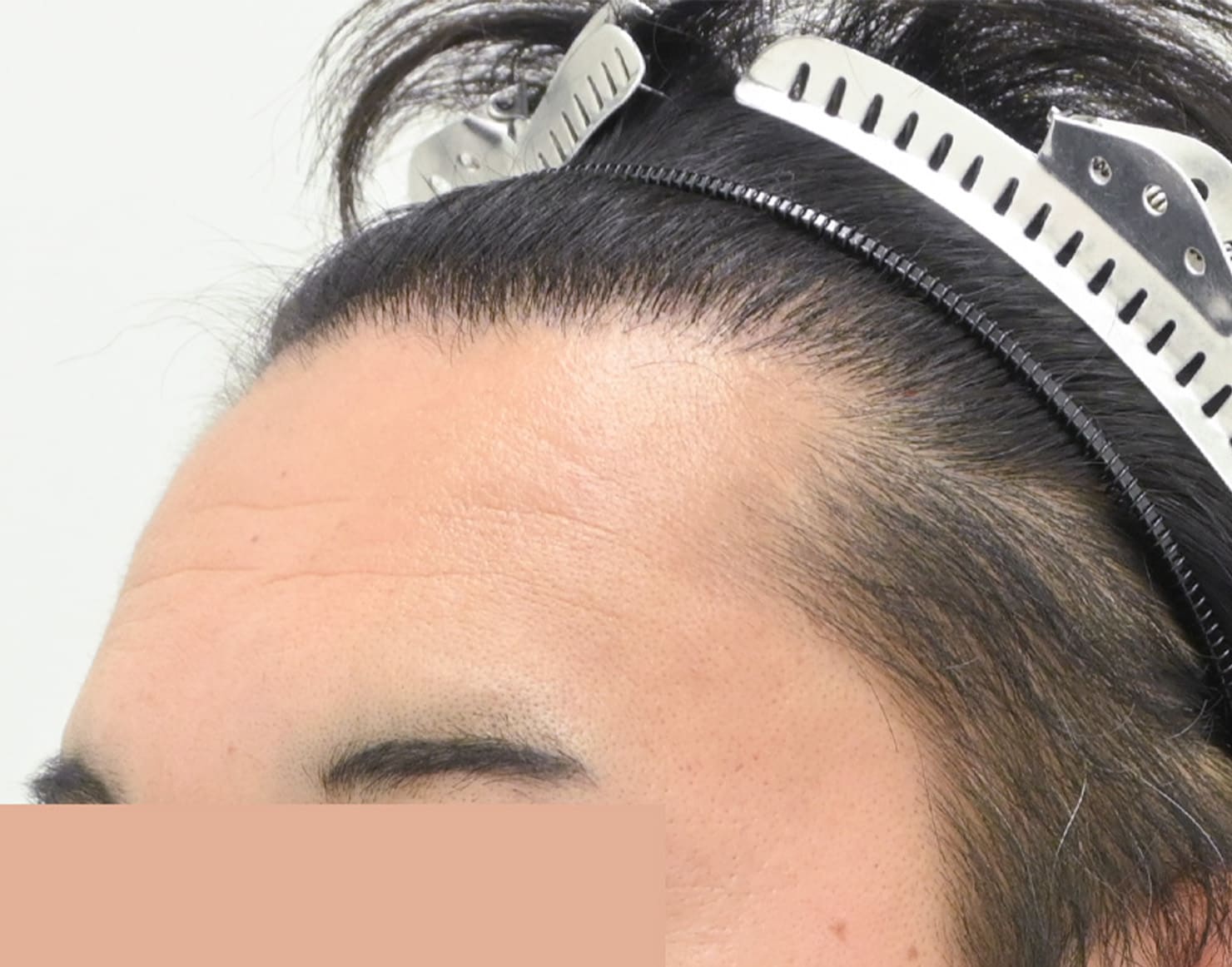 自毛 症例1 after