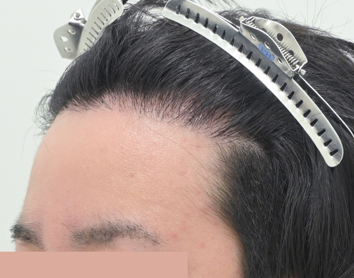 自毛 症例2 after