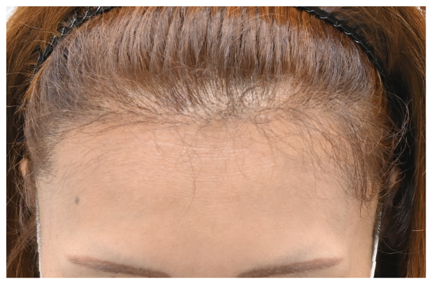 スマートFUE 症例1 after