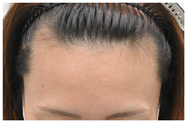 スマートFUE 症例1
