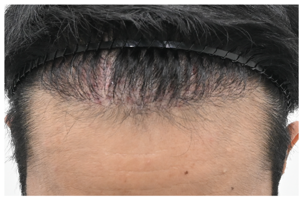 スマートFUE 症例2 after