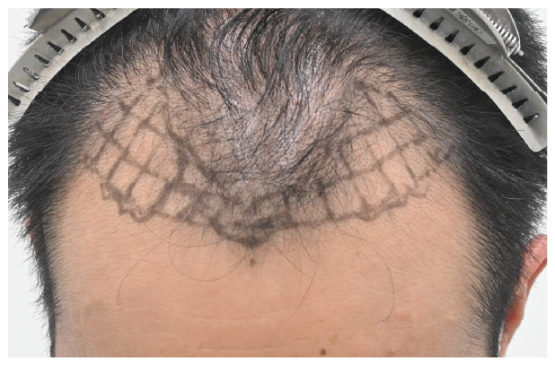スマートFUE 症例2