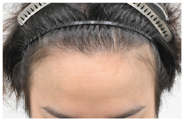 スマートFUE 症例3 after