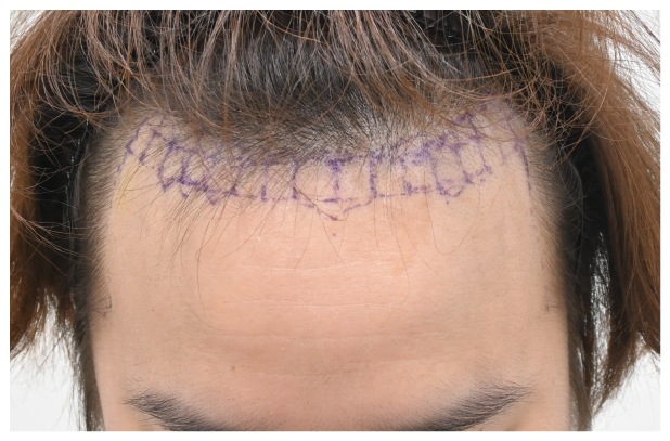 スマートFUE 症例3