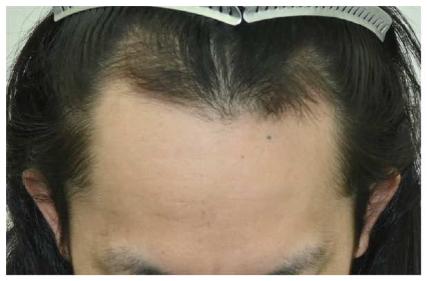 スマートFUE 症例4