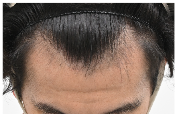 スマートFUE 症例5