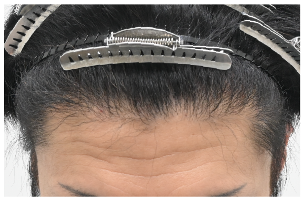 ノンシェーブン植毛 症例1 after