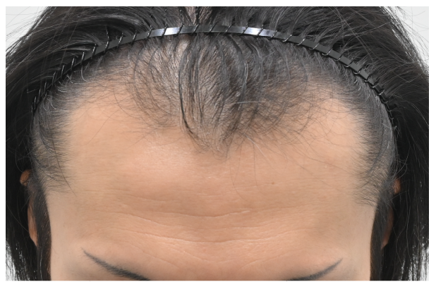 ノンシェーブン植毛 症例1