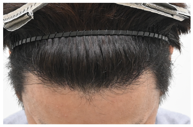 ノンシェーブン植毛 症例2 after
