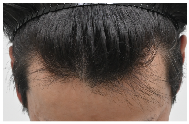 ノンシェーブン植毛 症例2