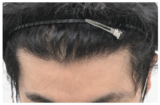 ノンシェーブン植毛 症例3 after