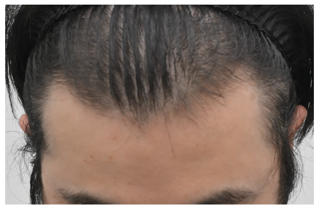 ノンシェーブン植毛 症例3