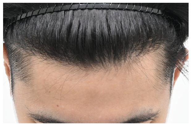 ノンシェーブン植毛 症例4 after