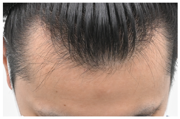 ノンシェーブン植毛 症例4