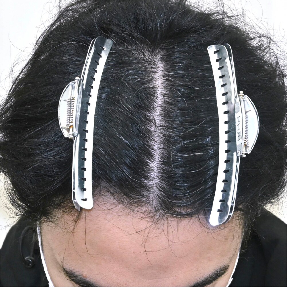 毛根再生注射×臍帯幹細胞上清液メソ 症例1　after