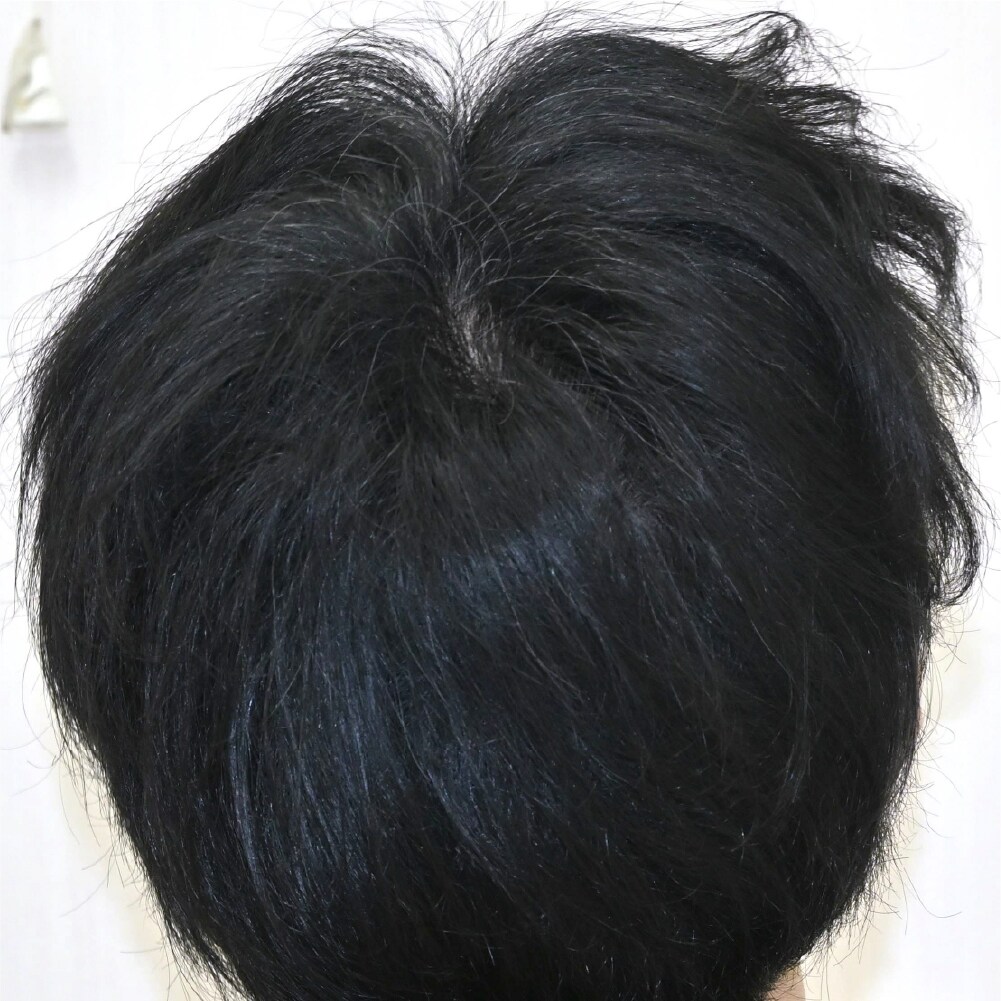 毛根再生注射×臍帯幹細胞上清液メソ 症例2 after