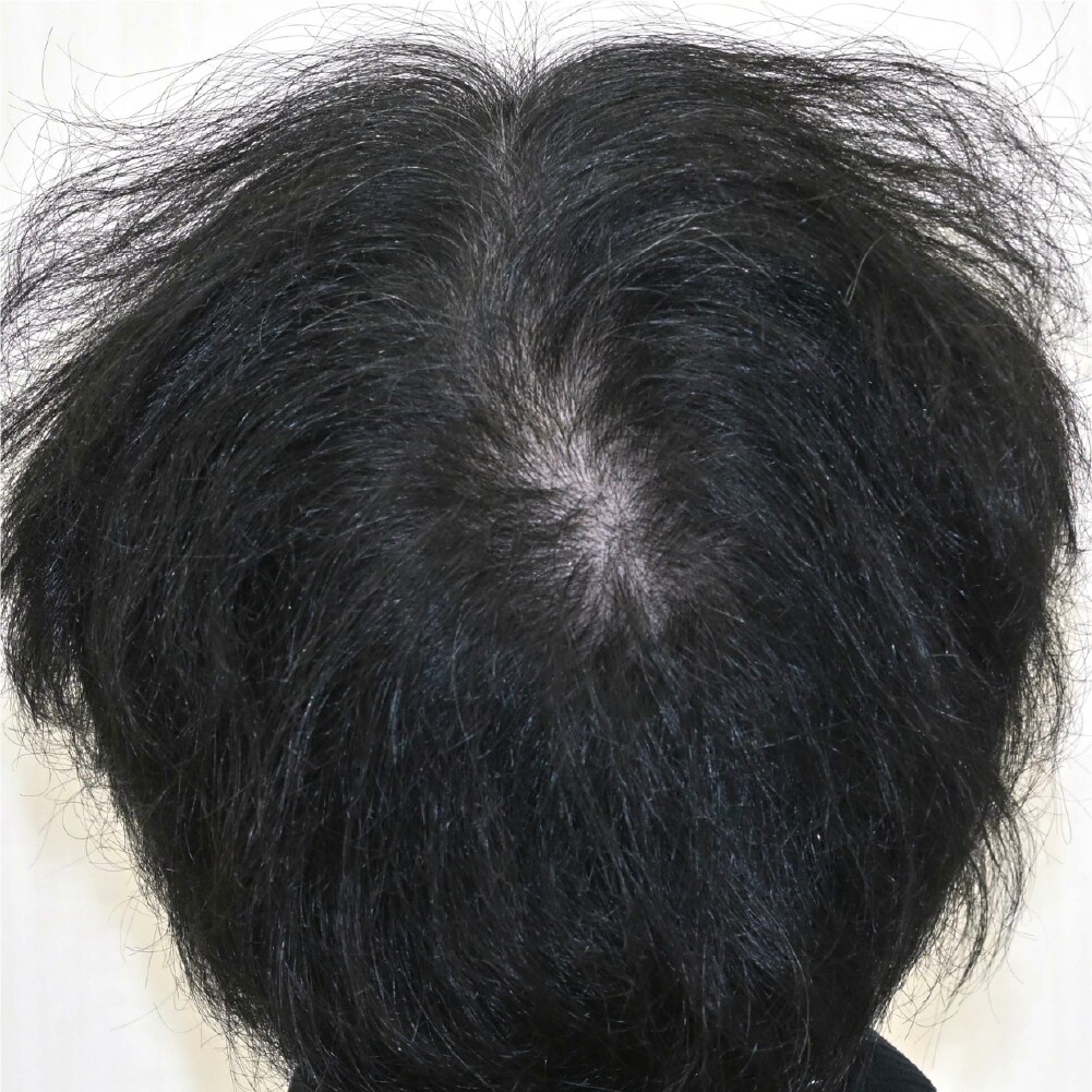 毛根再生注射×臍帯幹細胞上清液メソ 症例2