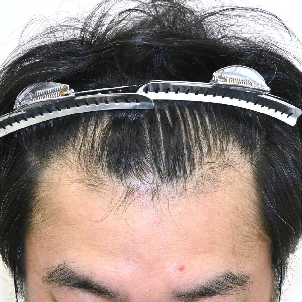 毛根再生注射×臍帯幹細胞上清液メソ 症例3 after