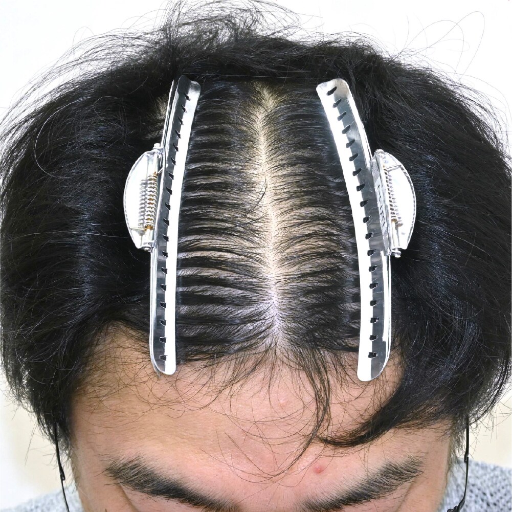 毛根再生注射×臍帯幹細胞上清液メソ 症例4 after
