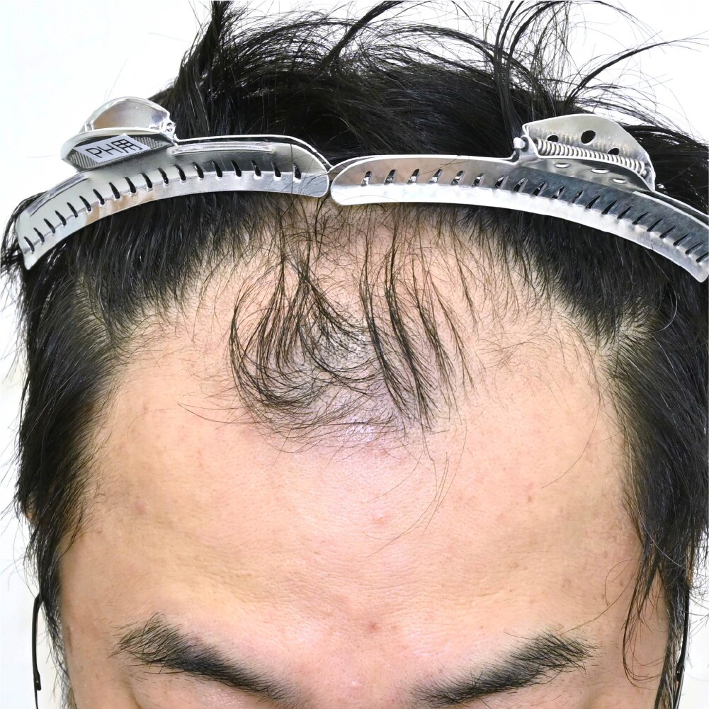 毛根再生注射×臍帯幹細胞上清液メソ 症例3