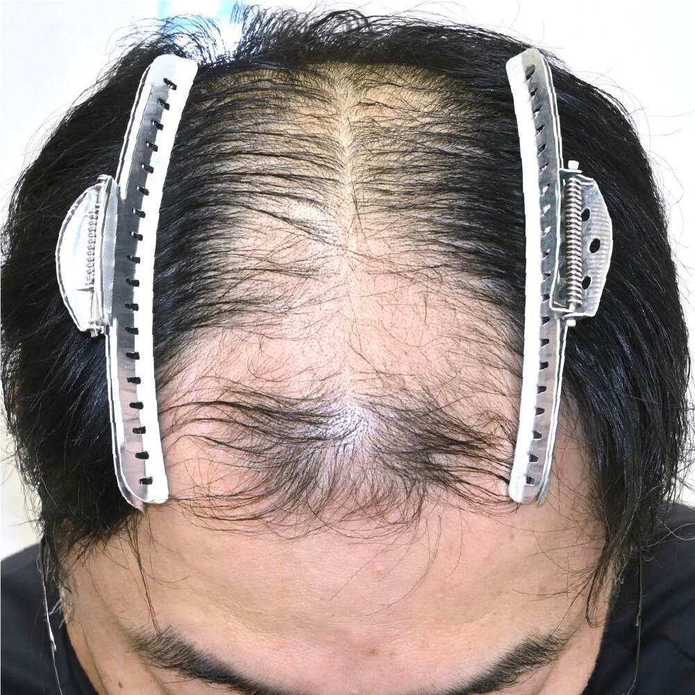 毛根再生注射×臍帯幹細胞上清液メソ 症例4