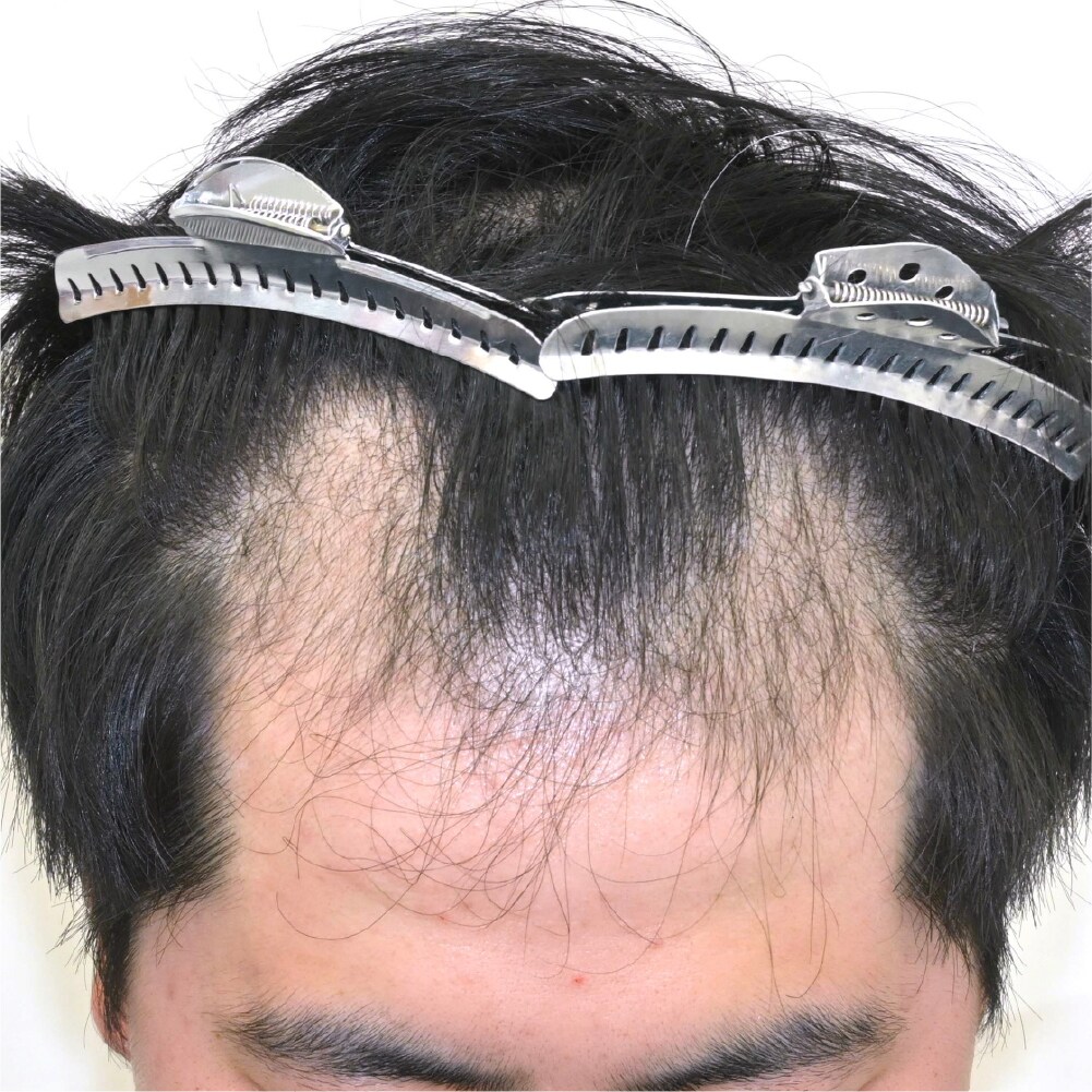 毛根再生注射×臍帯幹細胞上清液メソ 症例5