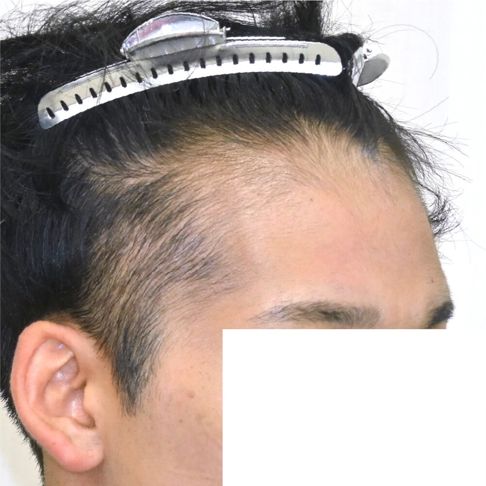 毛根再生注射×臍帯幹細胞上清液メソ 症例7 after