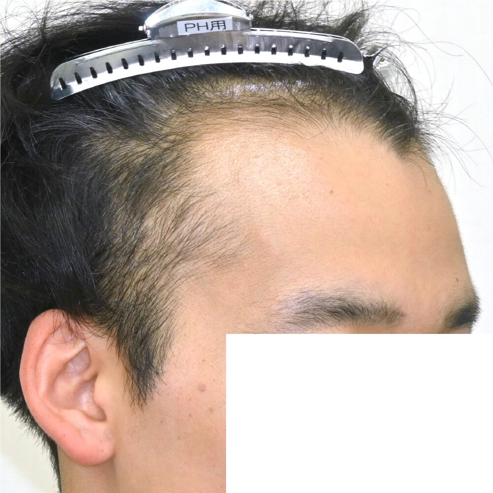 毛根再生注射×臍帯幹細胞上清液メソ 症例7