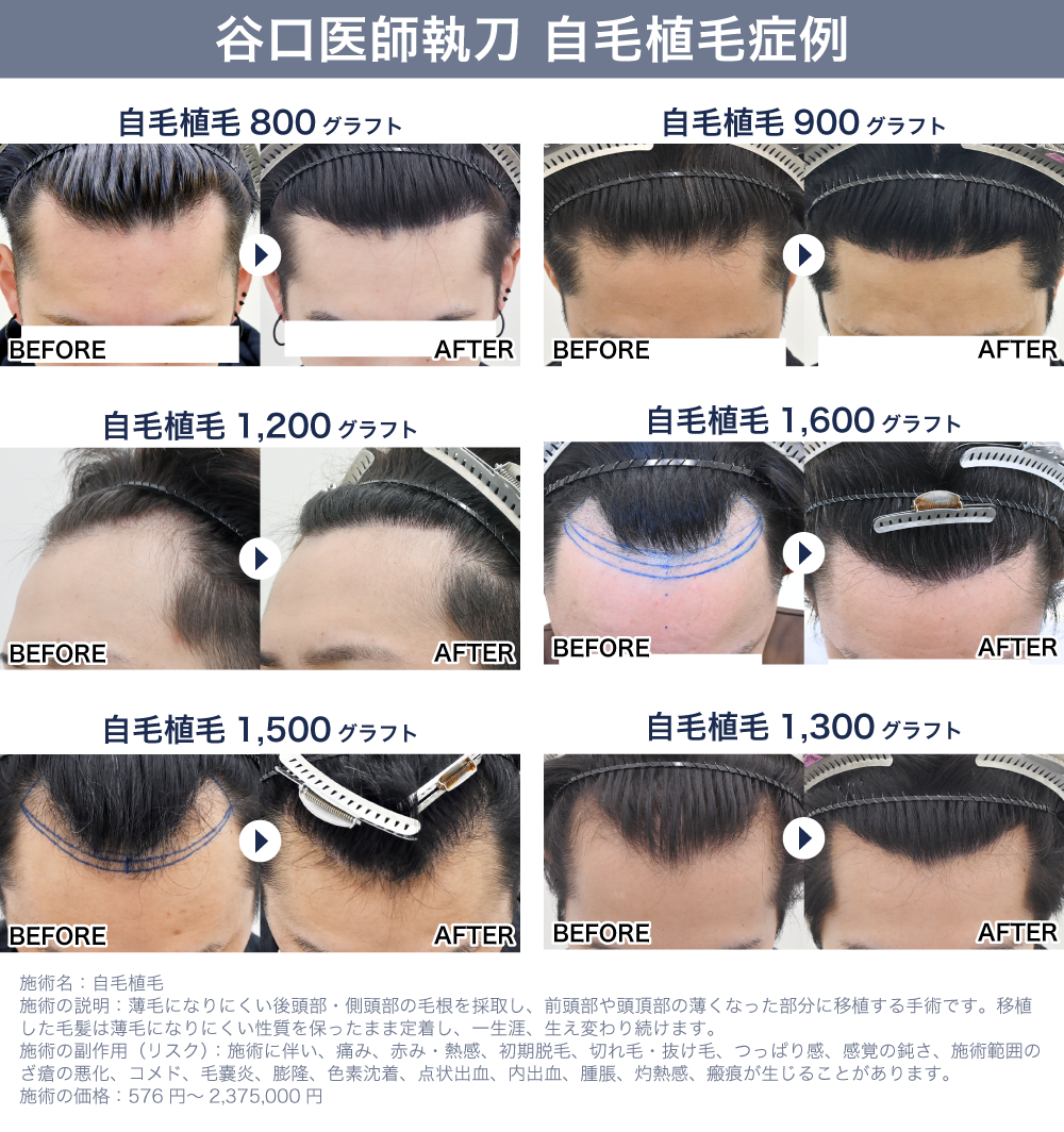 谷口医師 自毛植毛症例写真