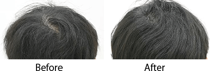 毛根再生注射 pickup症例写真3 before after