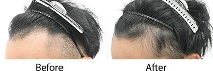 毛根再生注射 pickup症例写真4 before after