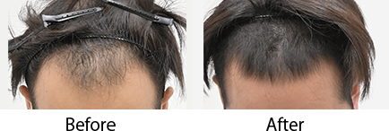 毛根再生注射 pickup症例写真8 before after