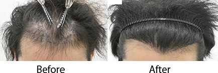 自毛植毛 pickup症例写真1 before after