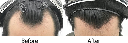 自毛植毛 pickup症例写真2 before after