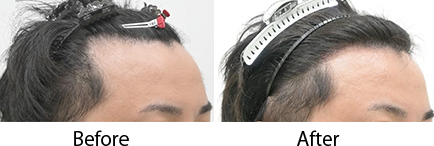 自毛植毛 pickup症例写真4 before after