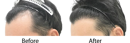 自毛植毛 pickup症例写真5 before after