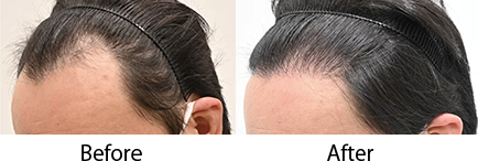 自毛植毛 pickup症例写真6 before after