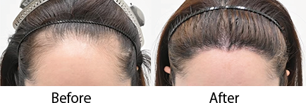 自毛植毛 pickup症例写真7 before after