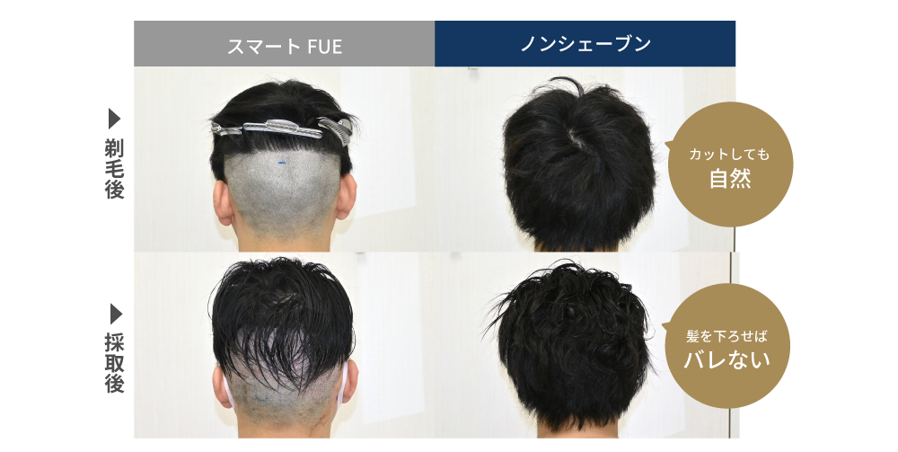 スマートFUE植毛とノンシェーブン植毛の違い
